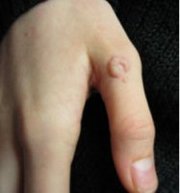 Удаление бородавок, родинок, папилом и т.д.