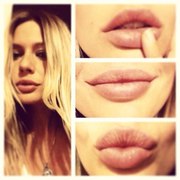 Увеличение губ/скул, контурная пластика, коррекция, косметические услуги