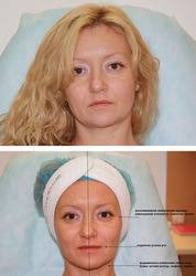 ГАЗОЖИДКОСТНЫЙ ПИЛИНГ + БЕЗИНЪЕКЦИОННАЯ МЕЗОТЕРАПИЯ 250 ГРН